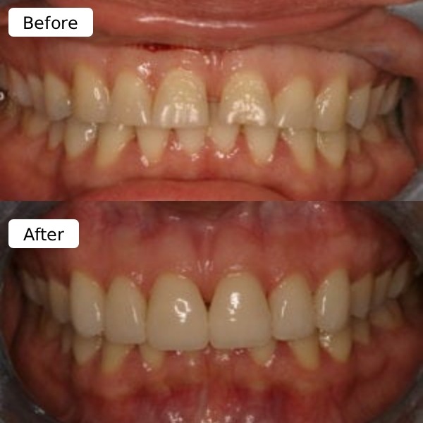 Full-mouth reconstruction sample