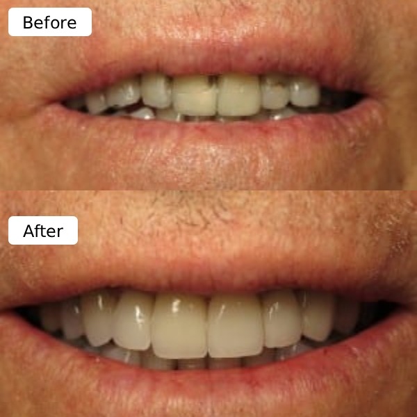 Full-mouth reconstruction sample