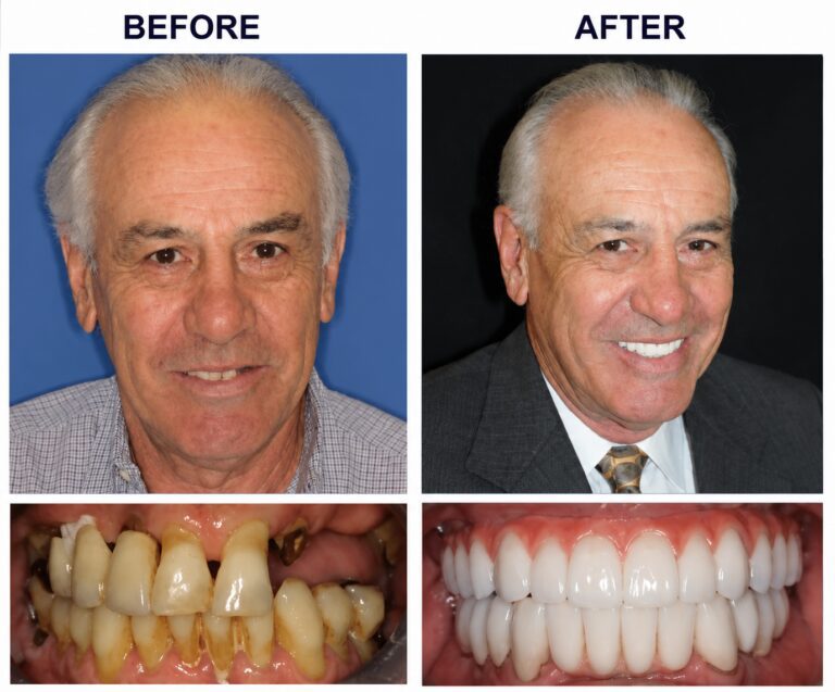 How Full Mouth Dental Implants Can Restore Your Smile and Confidence