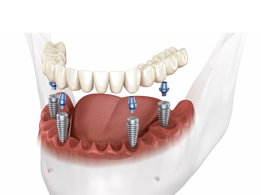 dental implant